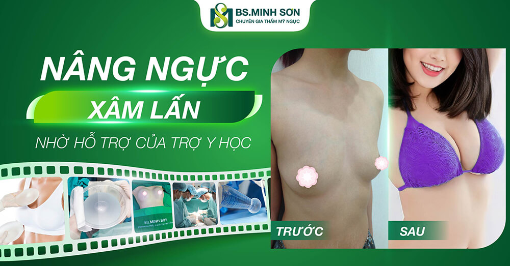 Hình ảnh trước sau nâng ngực xâm lấn