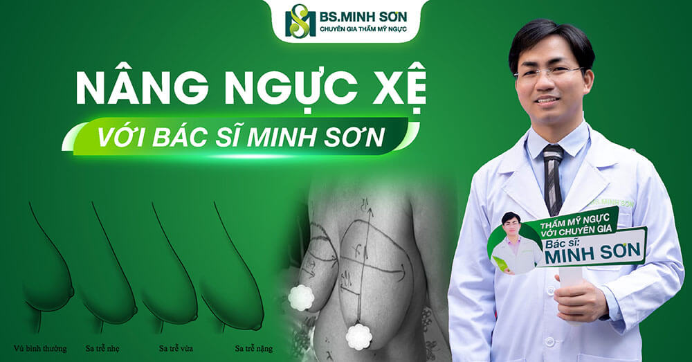 Nâng ngực xệ với Bác sĩ Minh Sơn