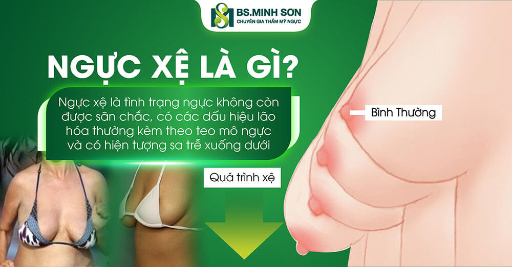 nguc xe la gi
