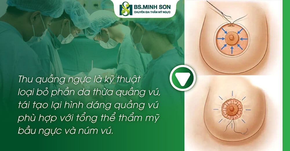Thu quầng ngực là gì