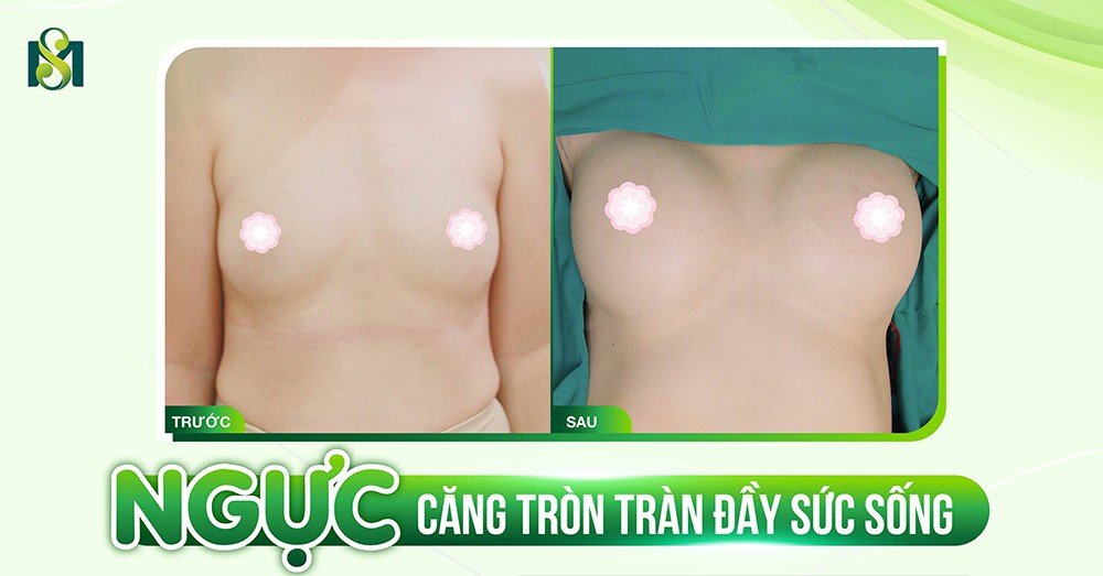 Hình ảnh trước và sau năng căng tròn tại Bác sĩ Minh Sơn
