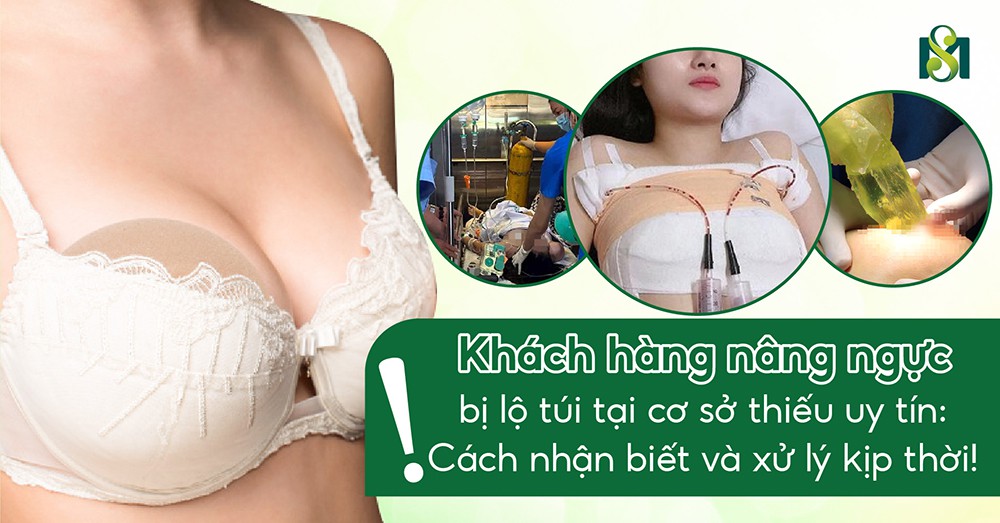 Nâng ngực bị lộ túi tại cơ sở thiếu uy tín