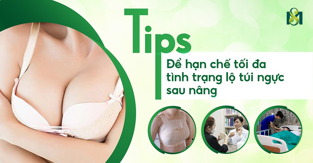 Tips để hạn chế tối đa tình trạng lộ túi ngực sau nâng