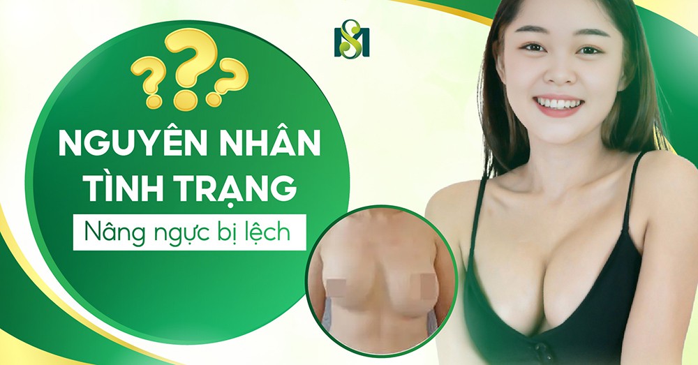 Nguyên nhân tình trạng nâng ngực bị lệch