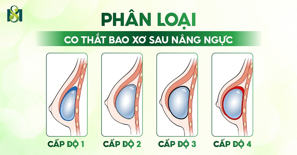 Phân loại co thắt bao xơ sau nâng ngực
